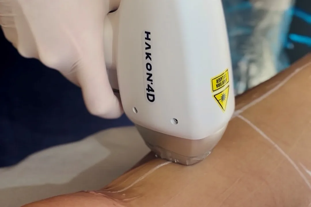 Aplicação de depilação a laser na GoLaser Barão Geraldo